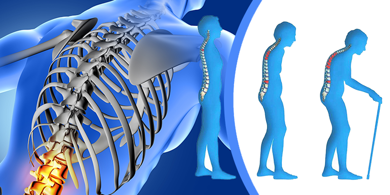 osteoporoza