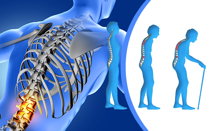 osteoporoza